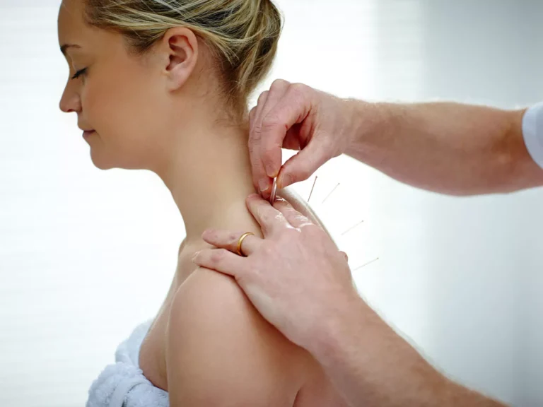 dry needling physio melbourne