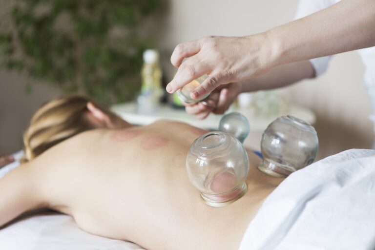 cupping therapy Melbourne